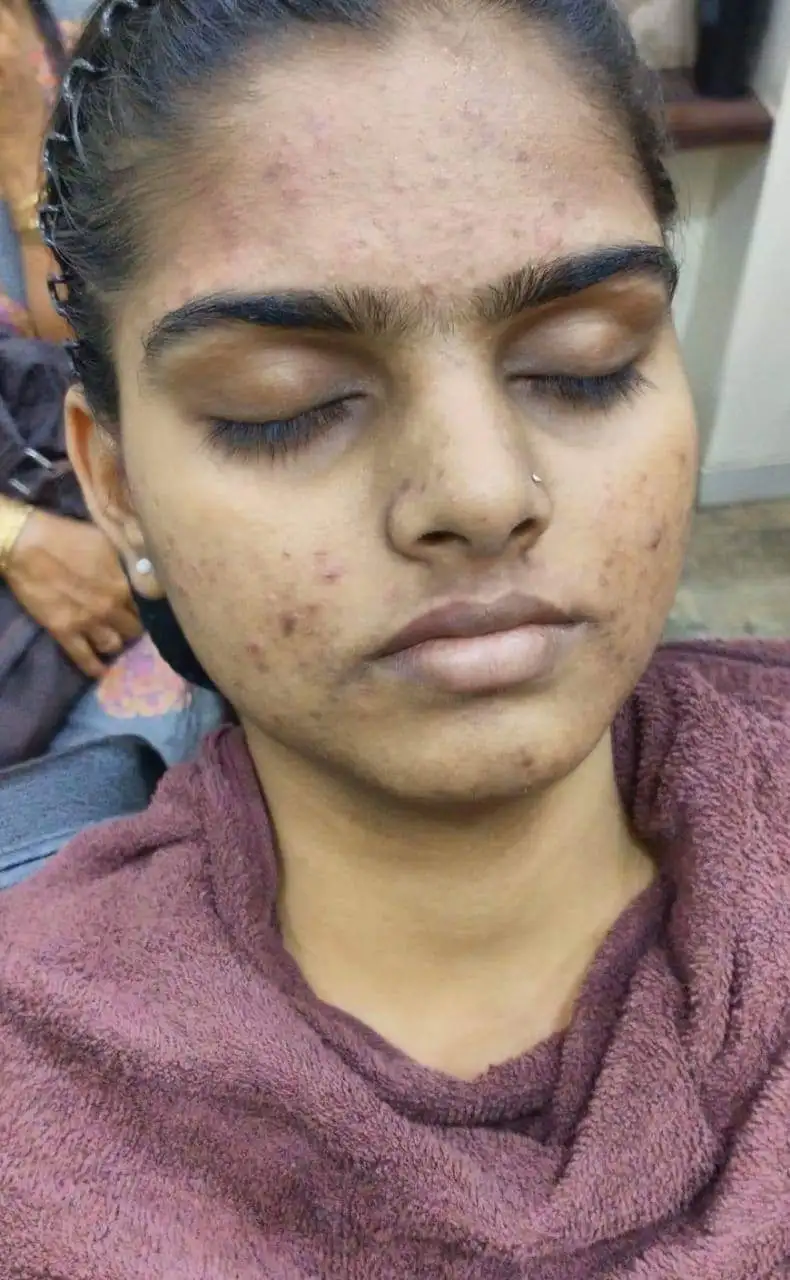 Skin Before